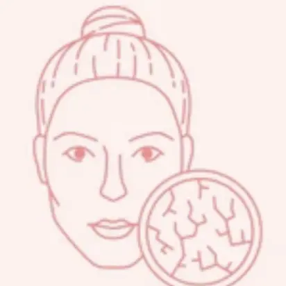 Чутлива / Розацеа